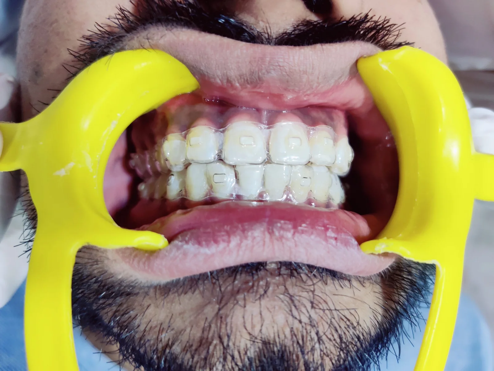 Before clear aligners