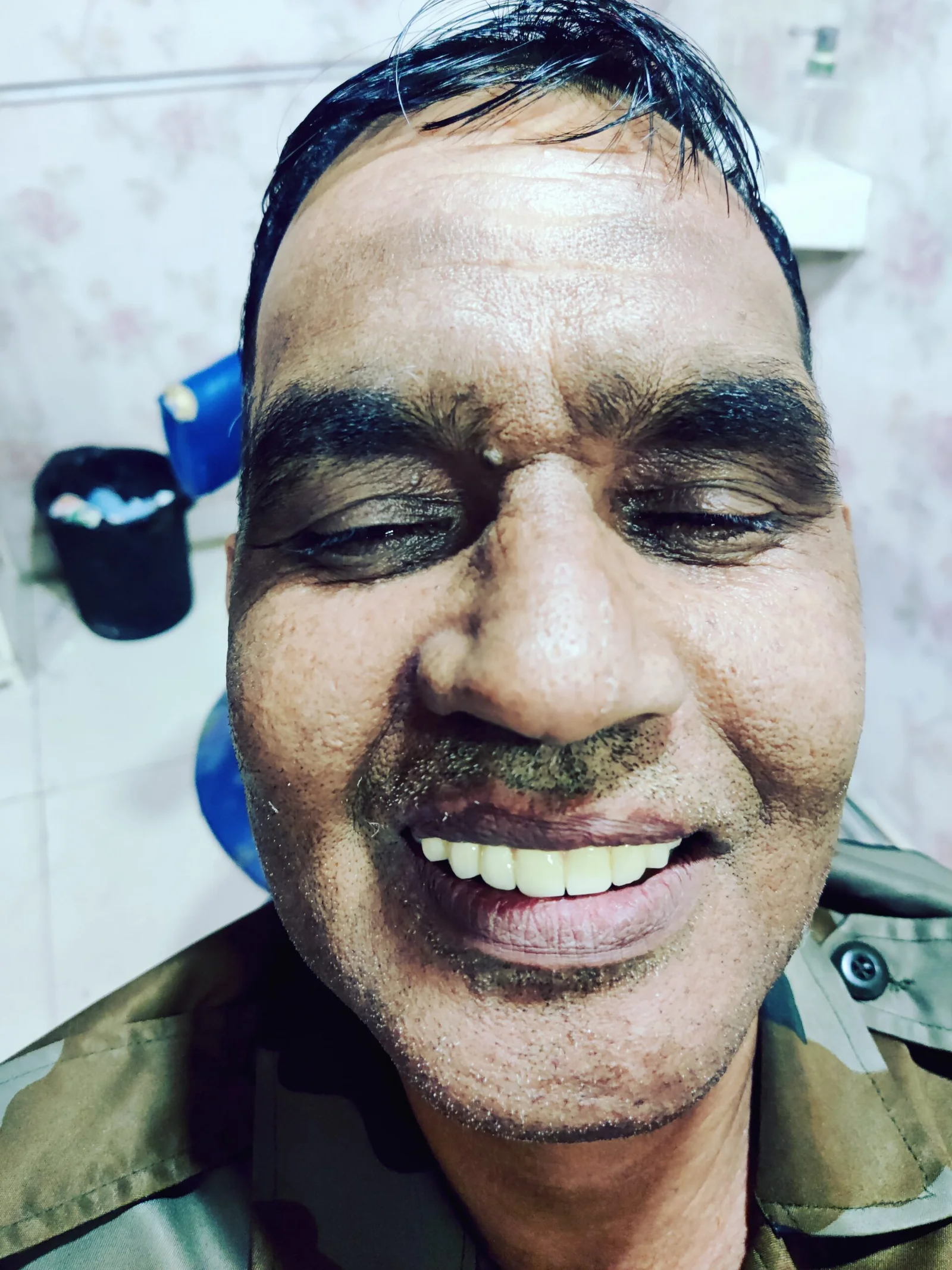 After full implants