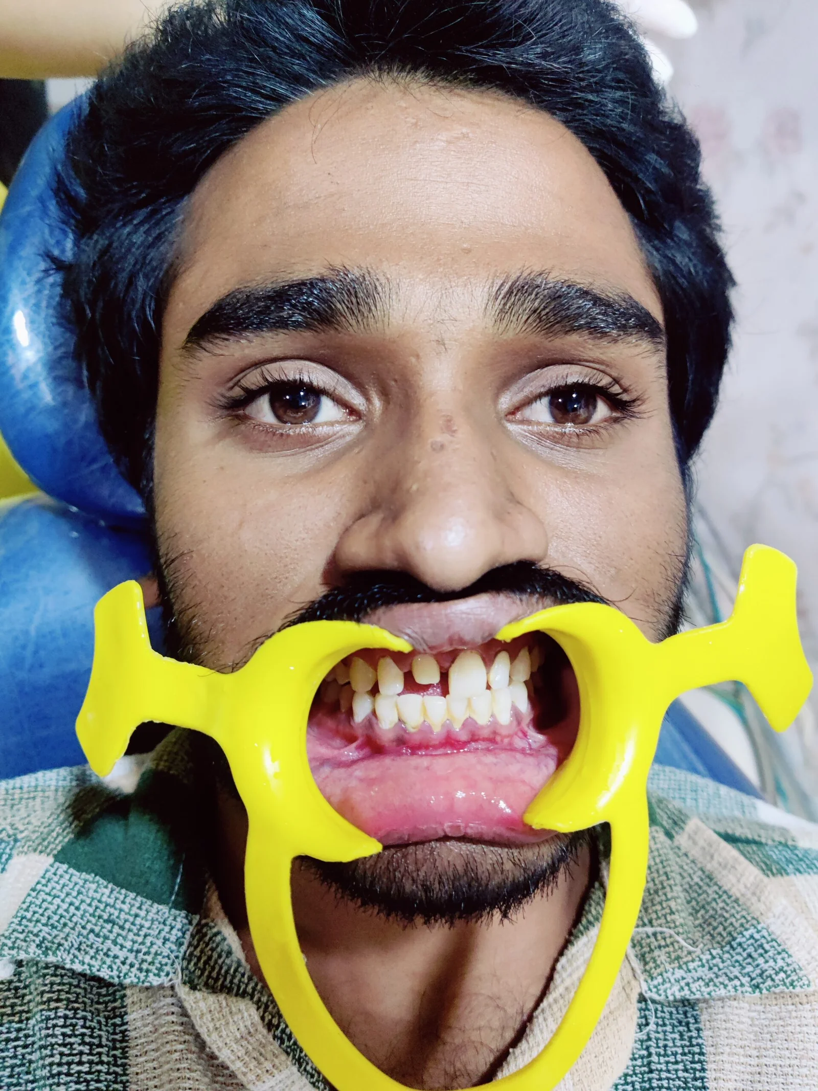 Before zirconia crown