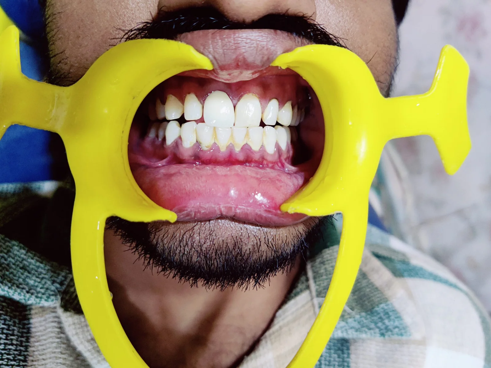 After zirconia crown
