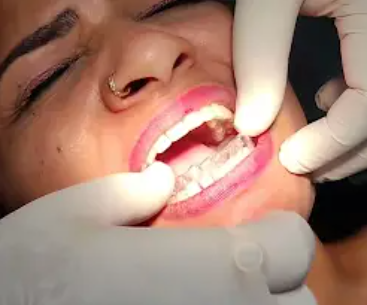 After clear aligners
