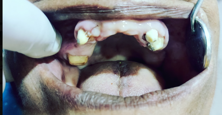 Full Arch Dental Implant Abutments