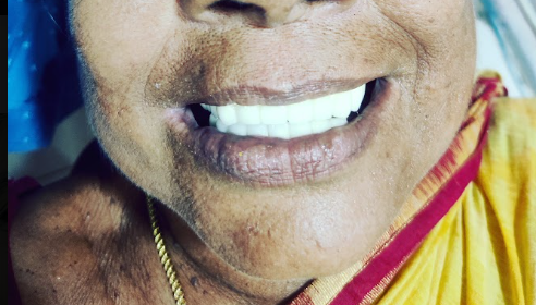 Full Mouth Implant Supported Bridge